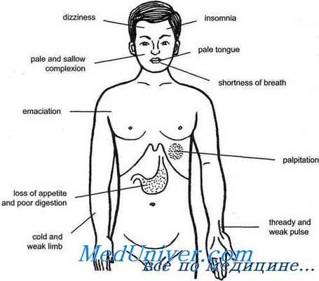 гипопитуитаризм