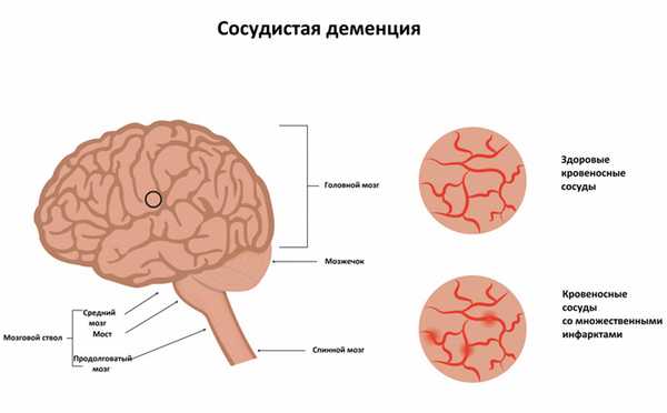 сосудистая деменция.jpg