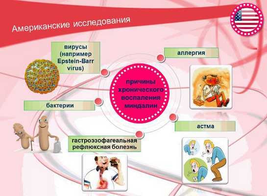 Причины хронического воспаления миндалин