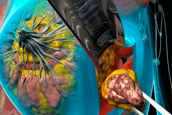 Лампэктомия: как не позволить раку молочных желез испортить жизнь?