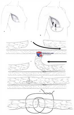 Модифицированная радикальная мастэктомия