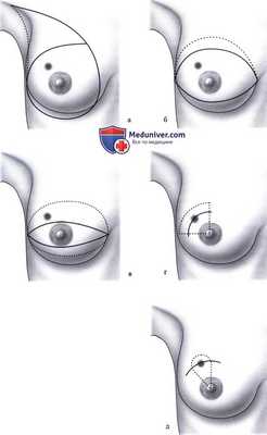 Варианты разрезов и объём операций при раке молочной железы