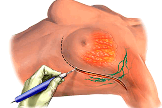 Лампэктомия: как не позволить раку молочных желез испортить жизнь?