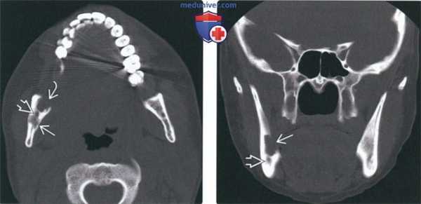 Рентгенограмма, КТ при лангергансоклеточном гистиоцитозе челюсти
