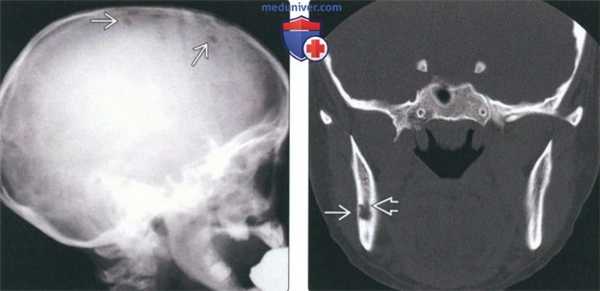 Рентгенограмма, КТ при лангергансоклеточном гистиоцитозе челюсти