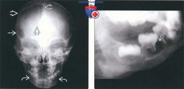 Рентгенограмма, КТ при лангергансоклеточном гистиоцитозе челюсти
