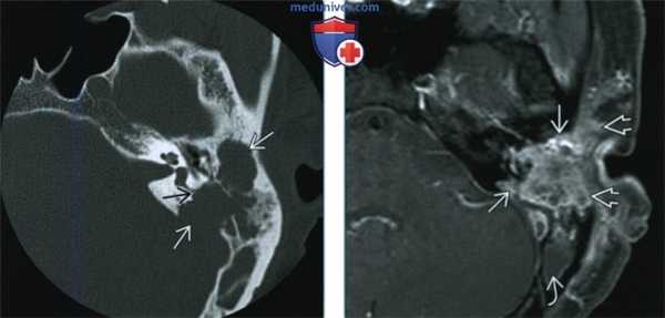 Лангергансоклеточный гистиоцитоз височной кости - лучевая диагностика