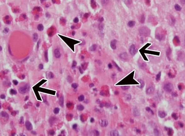 Гистиоцитоз из клеток Лангерганса