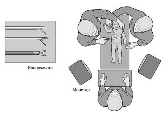 Лапароскопия при водянке яичка