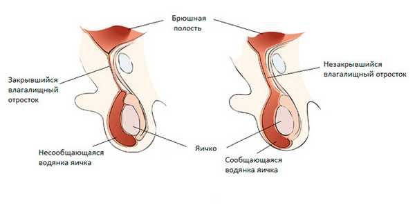 Сообщающаяся водянка яичка у новорожденных и детей