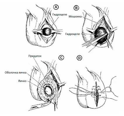 Схема операции из мошоночного доступа