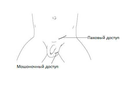 Паховый и мошоночный доступ