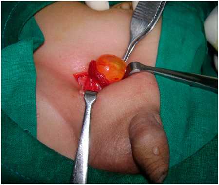 Этап хирургического вмешательства, когда яичко с водянкой выводится в рану