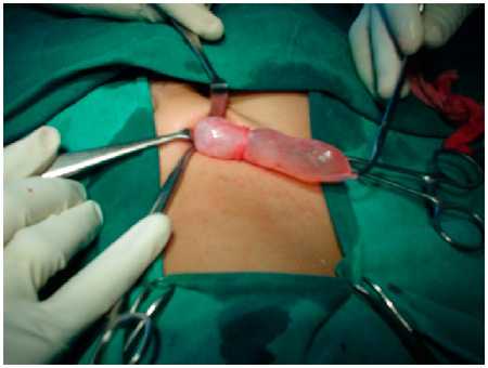 Этап операции, в процессе которого выделяют влагалищный отросток