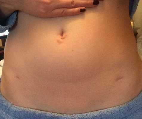 лапароскопия