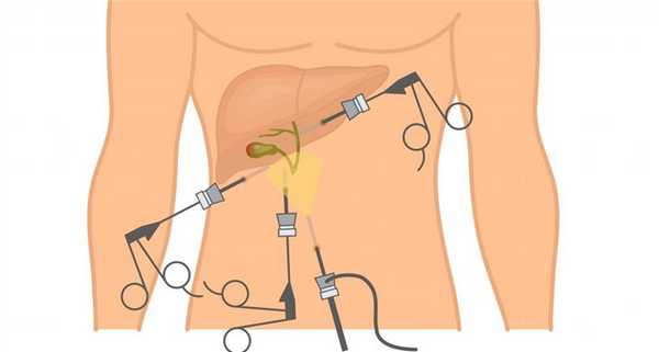 Лапароскопия в гастроэнтерологии