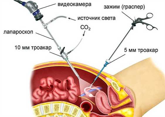 Лапароскопия