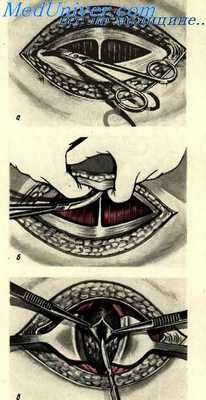 Лапаротомия по Пфаннеанштилю