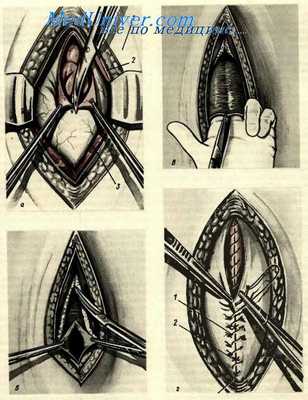 Нижняя срединная лапаротомия