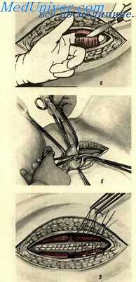 Вскрытие брюшной полости по методу Черни