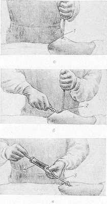Схематическое изображение методики лапароцентеза: а — после разреза кожи брюшная стенка однозубым крючком (1) оттянута кверху; б — прокол брюшной стенки троакаром (2); в — аспирация содержимого из брюшной полости через катетер (3) с помощью шприца (4).
