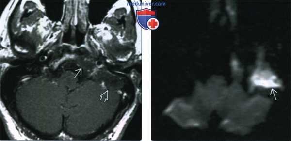 Врожденная мастоидальная холестеатома - лучевая диагностика