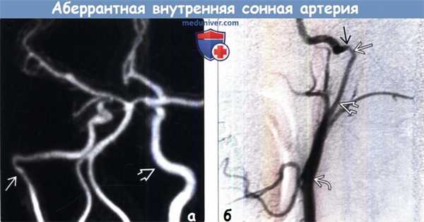 Аберрантная внутренняя сонная артерия на МРТ, ангиограмме