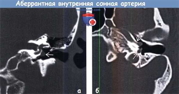 Аберрантная внутренняя сонная артерия на КТ, ангиограмме