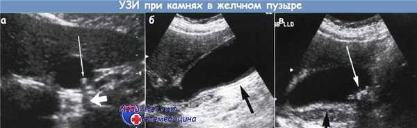 УЗИ камней в желчном пузыре