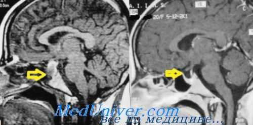 адипозо-генитальный синдром