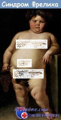 адипозо-генитальный синдром