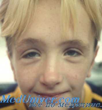 лечение акромегалии