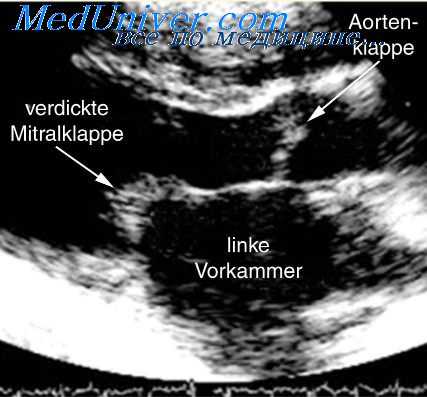 аневризмы сердца