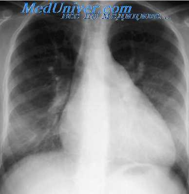 ишемическая болезнь сердца