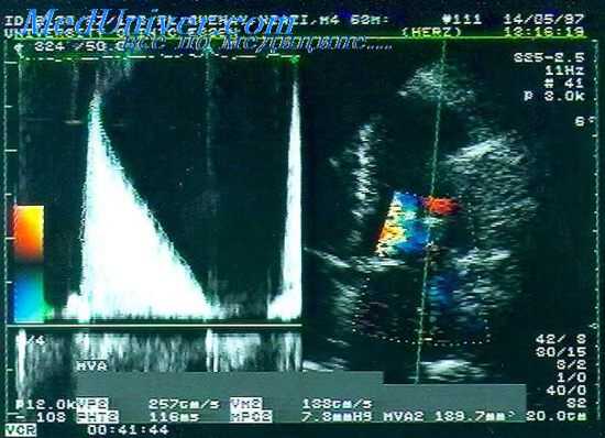 аневризмы сердца