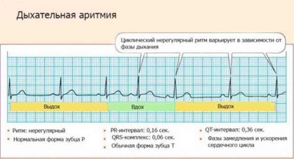 Дыхательная синусовая аритмия