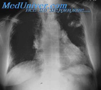 аспергиллез