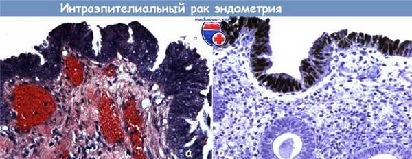 Рак эндометрия