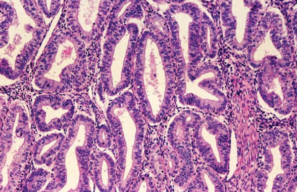 Атипическая гиперплазия эндометрия