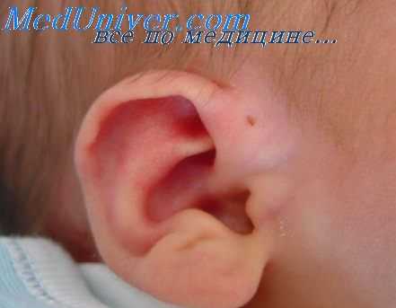 атрезия наружного слухового прохода
