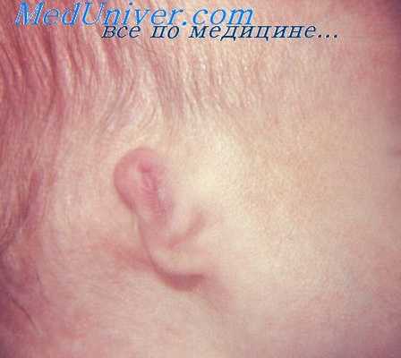восстановление наружного уха