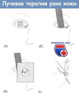 Лучевая терапия рака кожи нижнего века