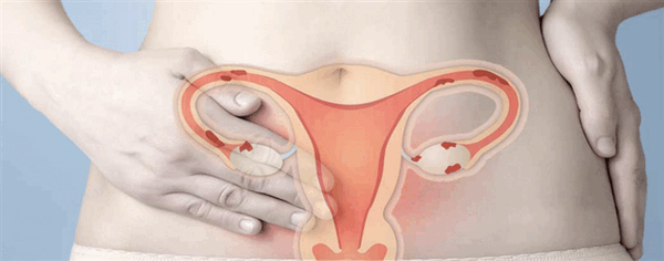 Экстракорпоральное оплодотворение и эндометриоз