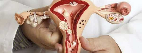 Можно ли делать ЭКО при эндометриозе - За Рождение