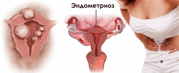 Беременность как лечение эндометриоза