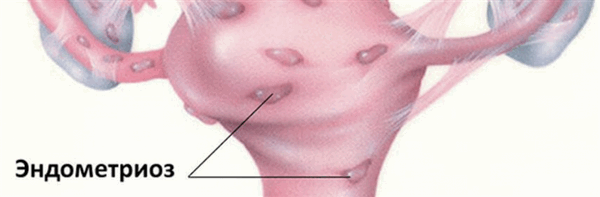 Как влияют друг на друга эндометриоз матки и беременность