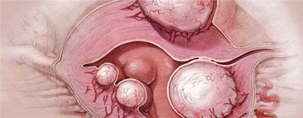 Эндометриоз и ЭКО - За Рождение