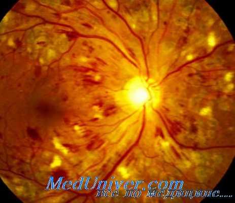 диабетическая ретинопатия