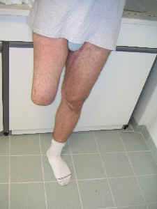 Боли после ампутации