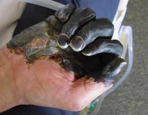 Сухая гангрена кисти